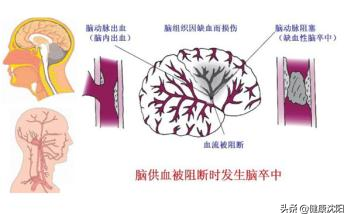 [健康知识普及行动] 重大疾病之卒中早识别，溶栓要尽早