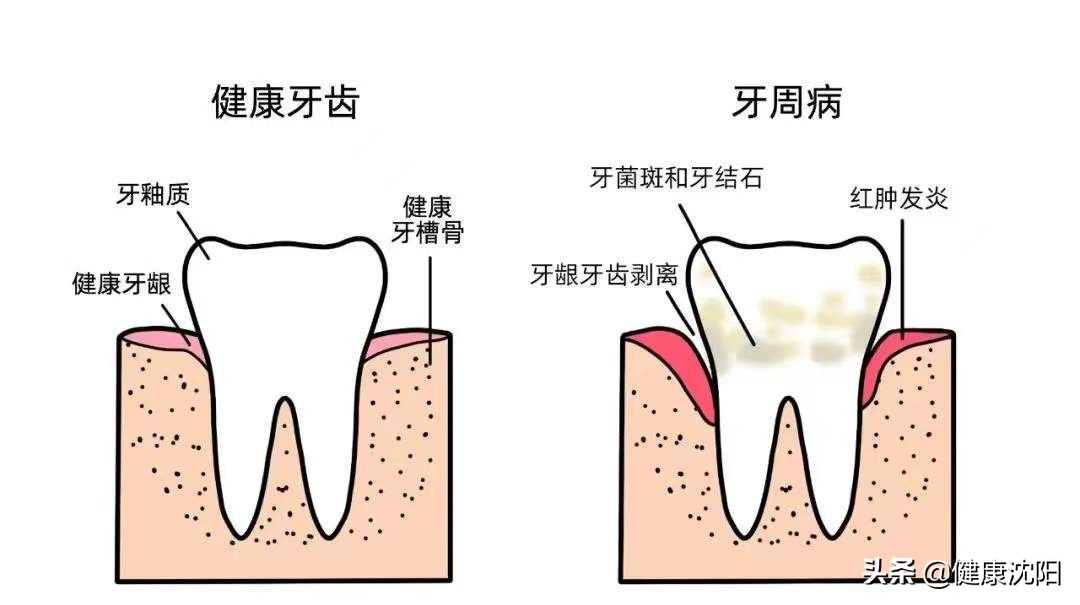 [健康知识普及行动] 口腔预防保健篇之专家和您聊聊牙周病相关事